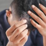 Hair loss